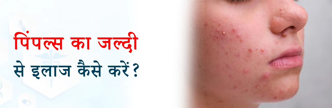  पिंपल्स का जल्दी से इलाज कैसे करें?